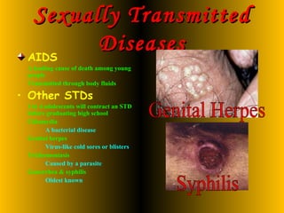 Sexually Transmitted Diseases AIDS A leading cause of death among young people Transmitted through body fluids Other STDs 1 in 4 adolescents will contract an STD before graduating high school Chlamydia A bacterial disease Genital herpes Virus-like cold sores or blisters Trichomoniasis Caused by a parasite Gonorrhea & syphilis Oldest known Genital Herpes Syphilis 