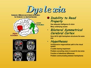 Dyslexia Inability to Read Properly Has adequate intelligence & vision Many underlying causes Bilateral Symmetrical Cerebral Cortex Have left & right hemisphere structures the same size Hypotheses Unresponsive magnocellular path to the visual system A subtle hearing impairment Problem converting vision to sound & vice-versa Function of attentional differences Problem communicating between hemispheres 