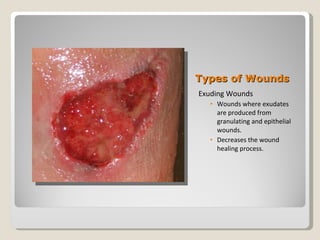 Chapter 19 Wound Management, Stoma And Incontinence Products | PPT