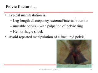 Pelvic fracture …
• Typical manifestation is
– Leg-length discrepancy, external/internal rotation
– unstable pelvis – with palpation of pelvic ring
– Hemorrhagic shock
• Avoid repeated manipulation of a fractured pelvis
JU, By: Mohammed A. (MSc.) 100
 