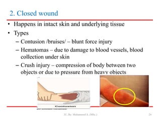 2. Closed wound
• Happens in intact skin and underlying tissue
• Types
– Contusion /bruises/ – blunt force injury
– Hematomas – due to damage to blood vessels, blood
collection under skin
– Crush injury – compression of body between two
objects or due to pressure from heavy objects
JU, By: Mohammed A. (MSc.) 24
 