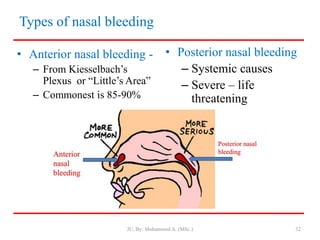 Types of nasal bleeding
• Anterior nasal bleeding -
– From Kiesselbach’s
Plexus or “Little’s Area”
– Commonest is 85-90%
• Posterior nasal bleeding
– Systemic causes
– Severe – life
threatening
JU, By: Mohammed A. (MSc.) 32
 