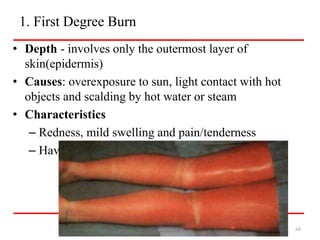 1. First Degree Burn
• Depth - involves only the outermost layer of
skin(epidermis)
• Causes: overexposure to sun, light contact with hot
objects and scalding by hot water or steam
• Characteristics
– Redness, mild swelling and pain/tenderness
– Have rapid healing
JU, By: Mohammed A. (MSc.) 68
 