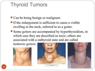 Thyroid Tumors
Can be being benign or malignant.
If the enlargement is sufficient to cause a visible
swelling in the neck, referred to as a goiter.
Some goiters are accompanied by hyperthyroidism, in
which case they are described as toxic; others are
associated with a euthyroid state and are called
nontoxic goiters.
45
 