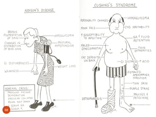 Cushing’s Syndrome
68
 