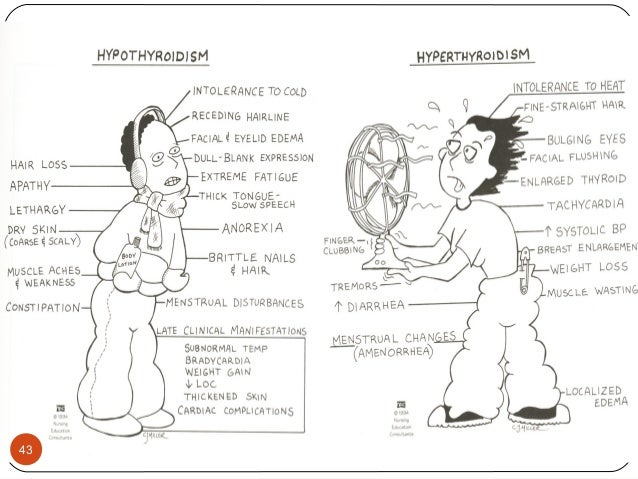 subtotal thyroidectomy