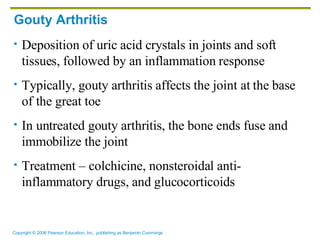 Gouty Arthritis Deposition of uric acid crystals in joints and soft tissues, followed by an inflammation response Typically, gouty arthritis affects the joint at the base of the great toe In untreated gouty arthritis, the bone ends fuse and immobilize the joint Treatment – colchicine, nonsteroidal anti-inflammatory drugs, and glucocorticoids 