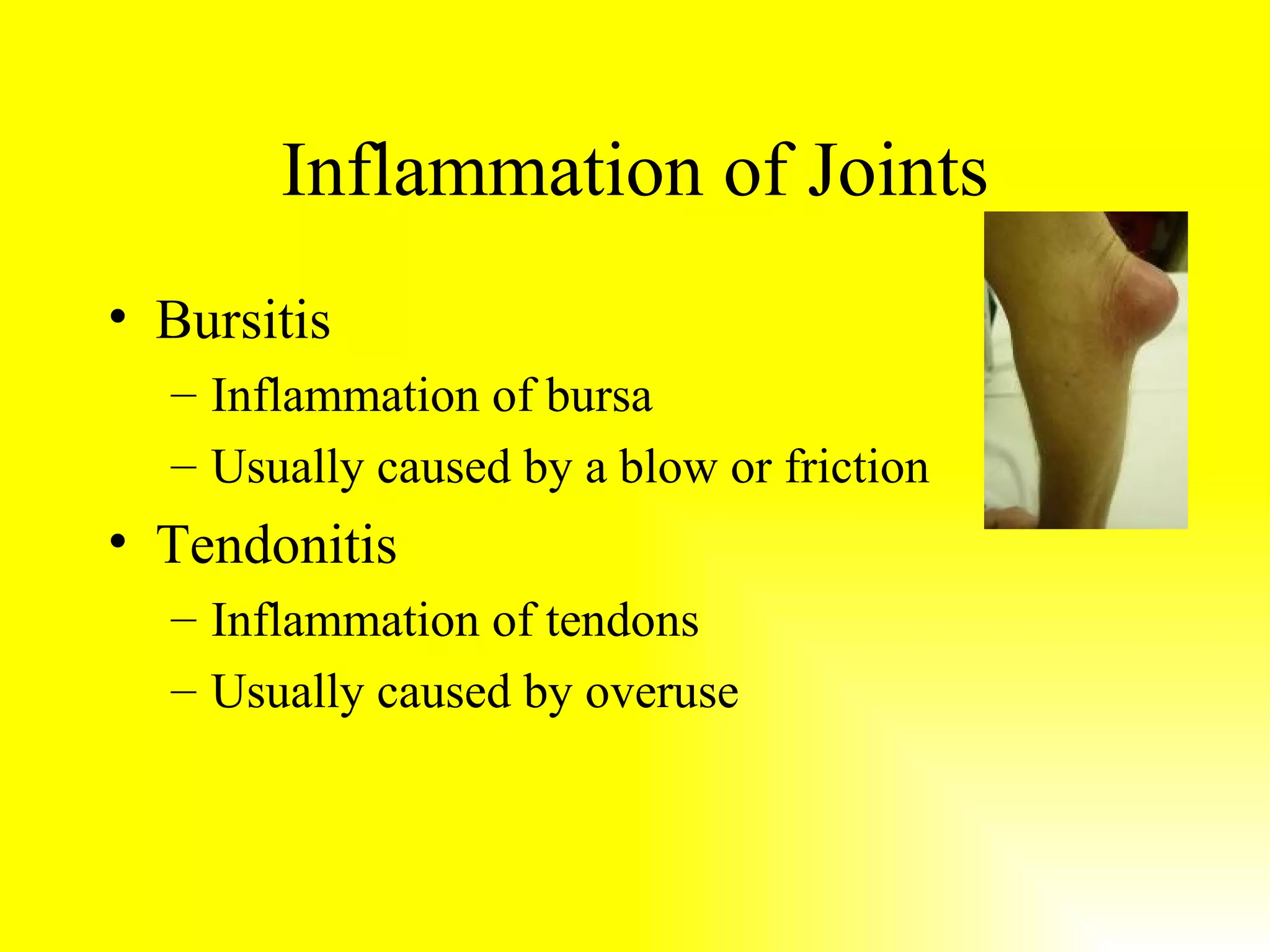 Inflammation of Joints Bursitis Inflammation of bursa Usually caused by a blow or friction Tendonitis Inflammation of tendons Usually caused by overuse