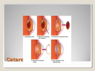 Cataract SurgeryCataract Surgery
 