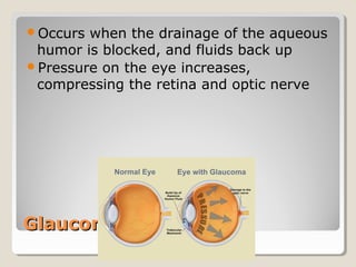 GlaucomaGlaucoma
Occurs when the drainage of the aqueous
humor is blocked, and fluids back up
Pressure on the eye increases,
compressing the retina and optic nerve
 