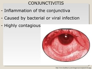 CONJUNCTIVITIS
- Inflammation of the conjunctiva
- Caused by bacterial or viral infection
- Highly contagious
http://www.healthseva.com/images/eye/conjunctivitis.jpg
 