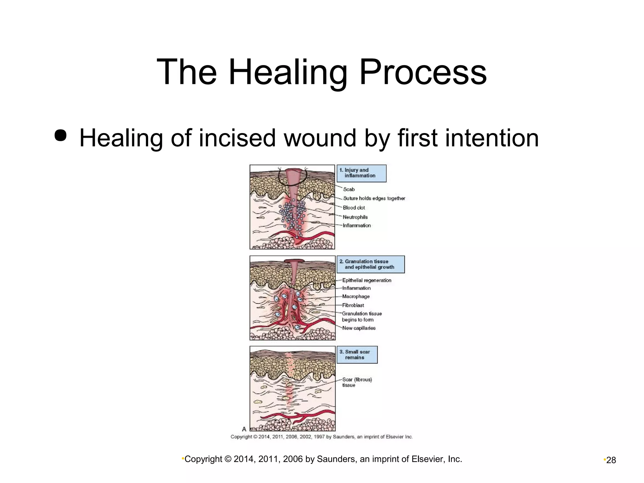 The Healing Process 
 Healing of incised wound by first intention 
•Copyright © 2014, 2011, 2006 by Saunders, an imprint of Elsevier, Inc. •28 
 