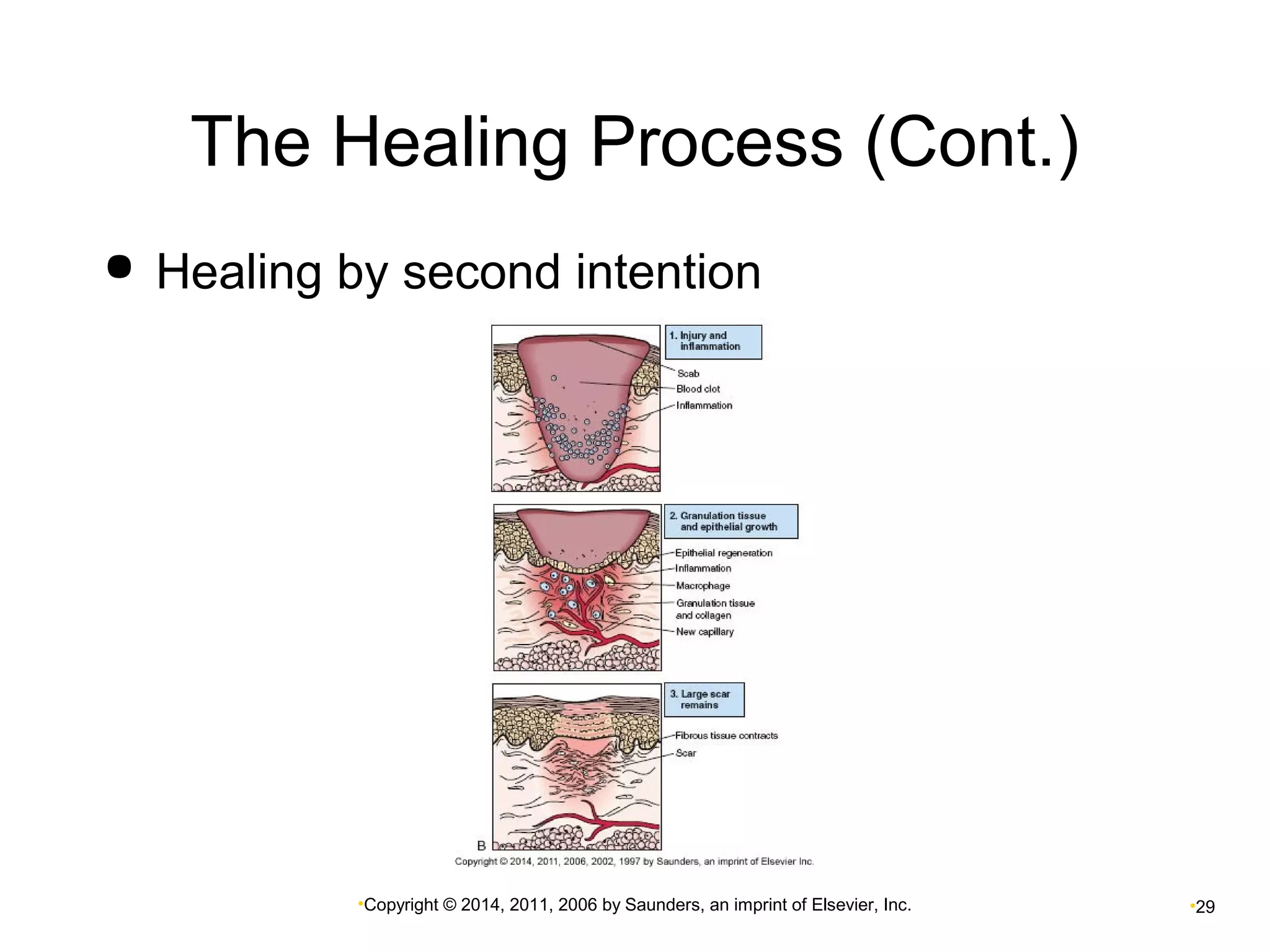 The Healing Process (Cont.) 
 Healing by second intention 
•Copyright © 2014, 2011, 2006 by Saunders, an imprint of Elsevier, Inc. •29 
 