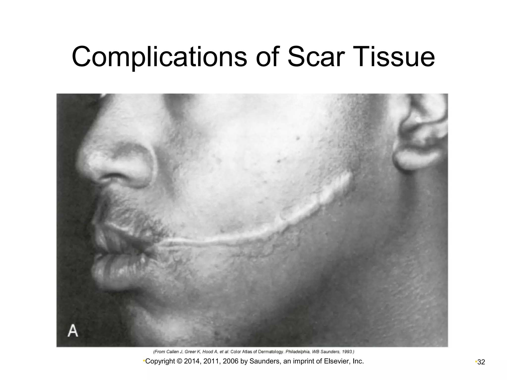 Complications of Scar Tissue 
•Copyright © 2014, 2011, 2006 by Saunders, an imprint of Elsevier, Inc. •32 
 
