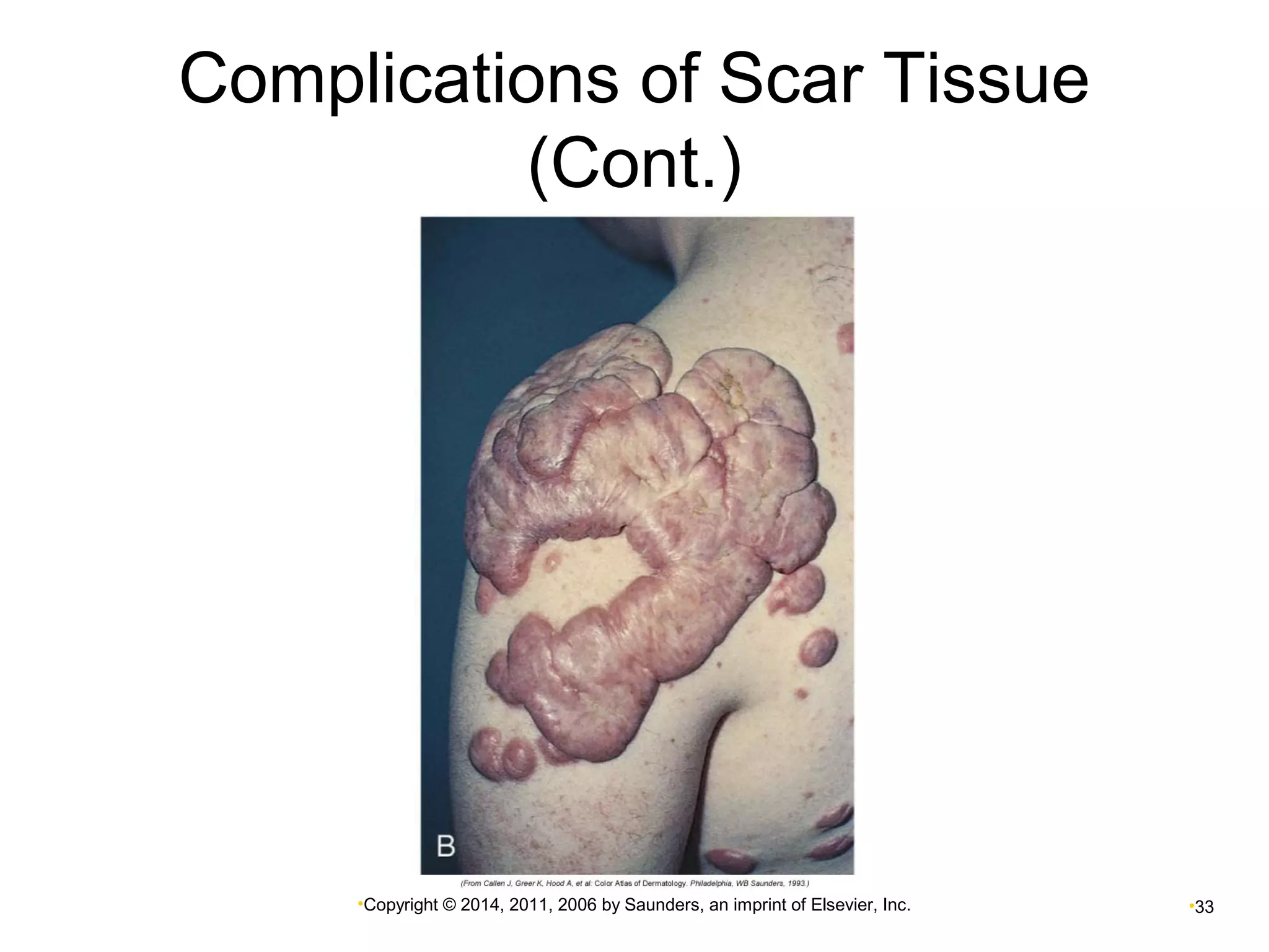 Complications of Scar Tissue 
(Cont.) 
•Copyright © 2014, 2011, 2006 by Saunders, an imprint of Elsevier, Inc. •33 
 
