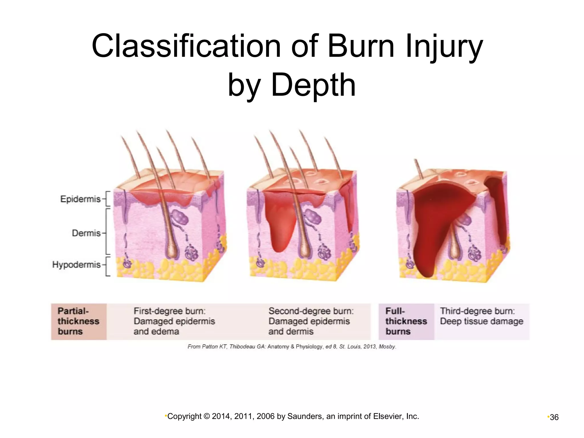 Classification of Burn Injury 
by Depth 
•Copyright © 2014, 2011, 2006 by Saunders, an imprint of Elsevier, Inc. •36 
 