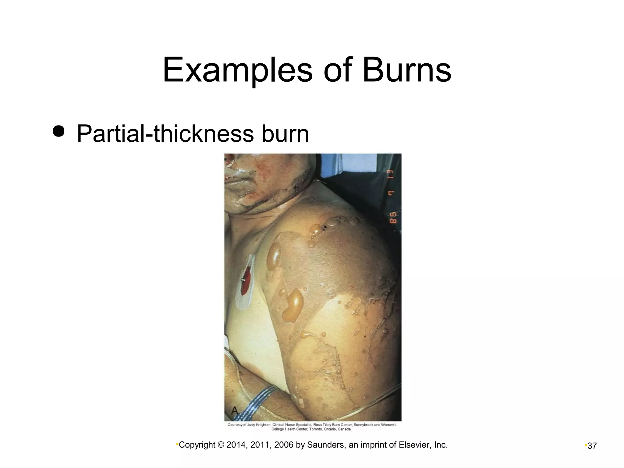 Examples of Burns 
 Partial-thickness burn 
•Copyright © 2014, 2011, 2006 by Saunders, an imprint of Elsevier, Inc. •37 
 