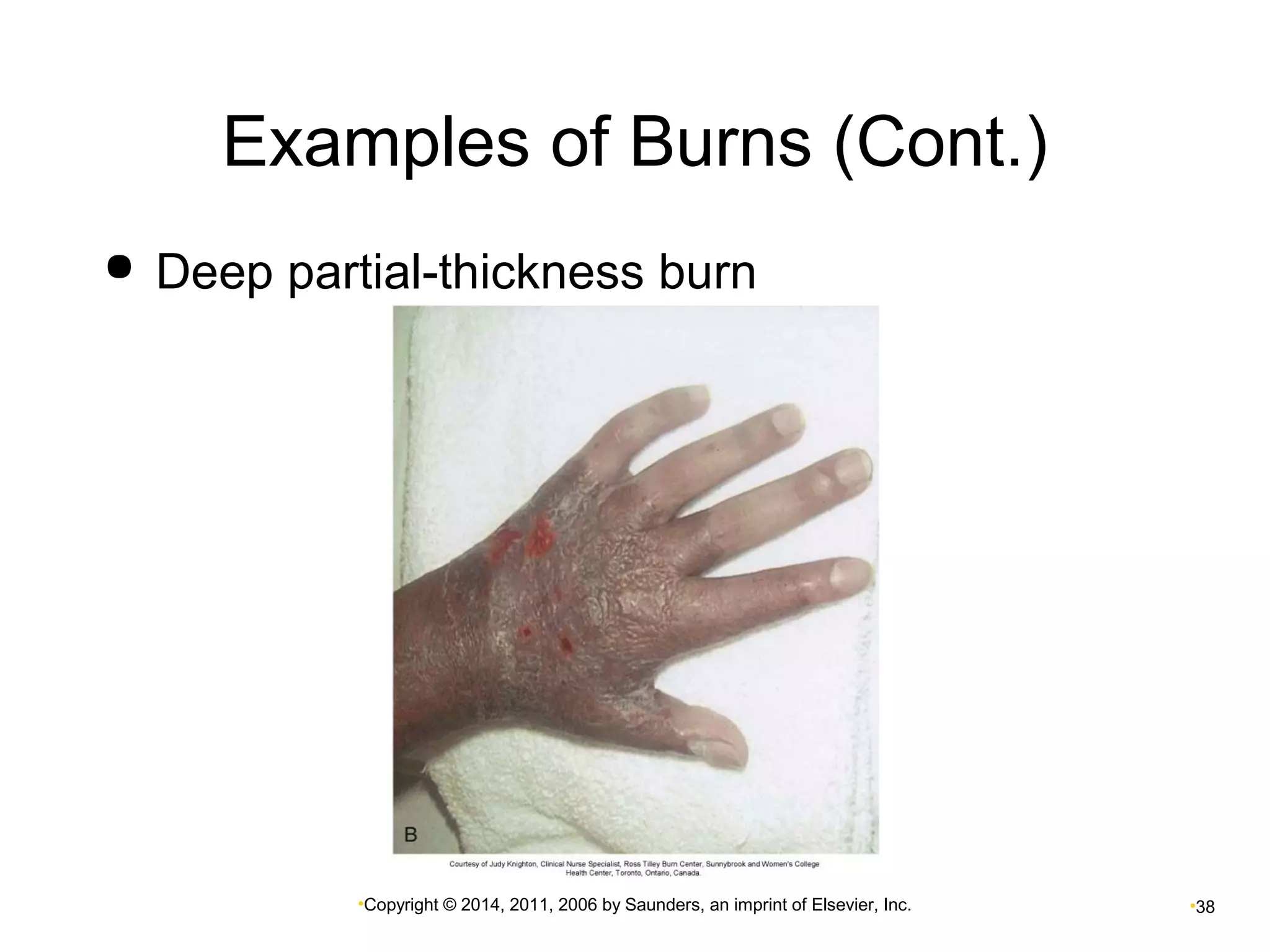 Examples of Burns (Cont.) 
 Deep partial-thickness burn 
•Copyright © 2014, 2011, 2006 by Saunders, an imprint of Elsevier, Inc. •38 
 