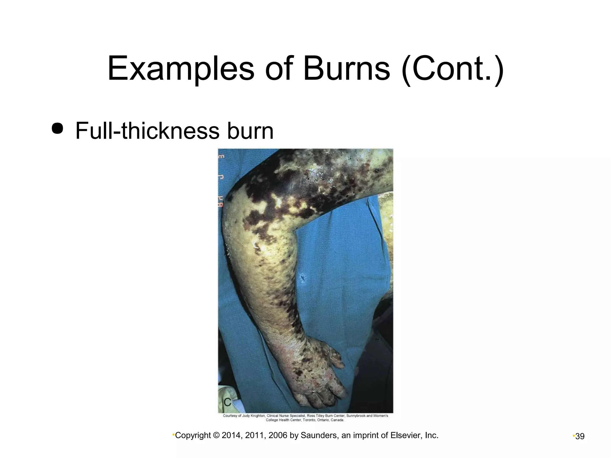 Examples of Burns (Cont.) 
 Full-thickness burn 
•Copyright © 2014, 2011, 2006 by Saunders, an imprint of Elsevier, Inc. •39 
 