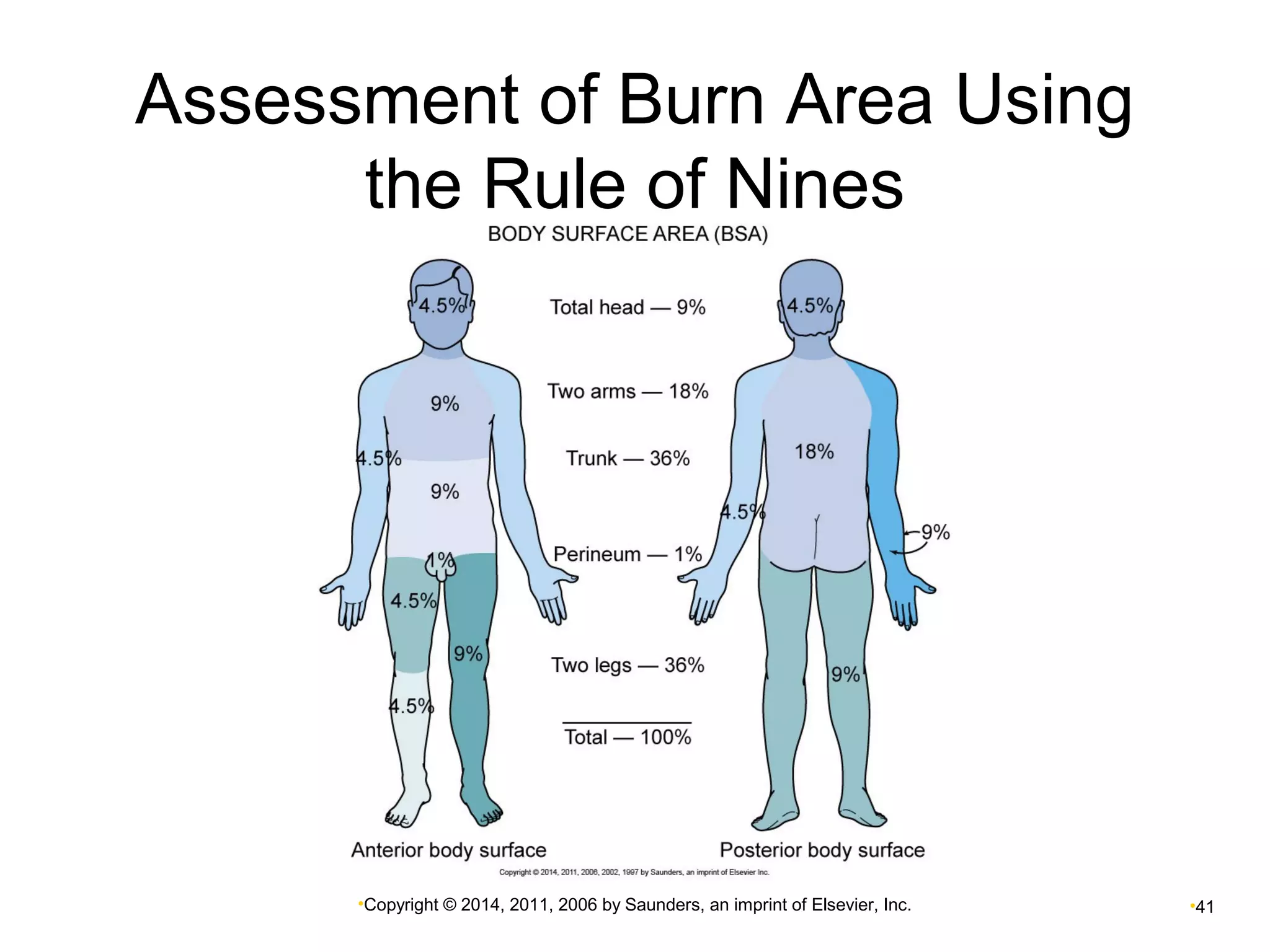 Assessment of Burn Area Using 
the Rule of Nines 
•Copyright © 2014, 2011, 2006 by Saunders, an imprint of Elsevier, Inc. •41 
 
