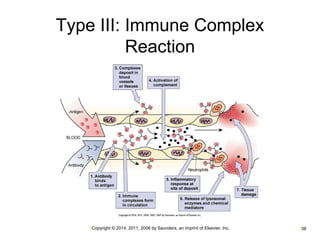 Type III: Immune Complex 
Reaction 
•Copyright © 2014, 2011, 2006 by Saunders, an imprint of Elsevier, Inc. •38 
 