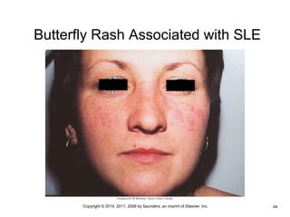 Butterfly Rash Associated with SLE 
•Copyright © 2014, 2011, 2006 by Saunders, an imprint of Elsevier, Inc. •44 
 