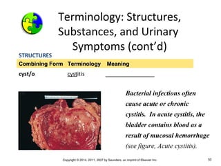 Copyright © 2014, 2011, 2007 by Saunders, an imprint of Elsevier Inc. 50
STRUCTURES
cyst/o cystitis ________________
Combining Form Terminology MeaningCombining Form Terminology Meaning
Terminology: Structures,
Substances, and Urinary
Symptoms (cont’d)
Bacterial infections often
cause acute or chronic
cystitis. In acute cystitis, the
bladder contains blood as a
result of mucosal hemorrhage
(see figure, Acute cystitis).
 