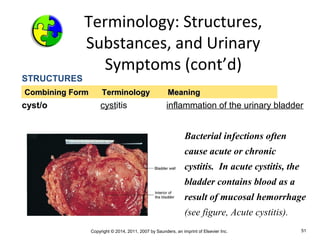 Copyright © 2014, 2011, 2007 by Saunders, an imprint of Elsevier Inc. 51
STRUCTURES
cyst/o cystitis inflammation of the urinary bladder
Combining Form Terminology MeaningCombining Form Terminology Meaning
Bacterial infections often
cause acute or chronic
cystitis. In acute cystitis, the
bladder contains blood as a
result of mucosal hemorrhage
(see figure, Acute cystitis).
Terminology: Structures,
Substances, and Urinary
Symptoms (cont’d)
 