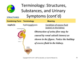 Copyright © 2014, 2011, 2007 by Saunders, an imprint of Elsevier Inc. 55
Terminology: Structures,
Substances, and Urinary
Symptoms (cont’d)STRUCTURES
nephr/o hydronephrosis Condition of excess fluid
(water) in the kidney
Combining Form TerminologyCombining Form Terminology MeaningMeaning
Obstruction of urine flow may be
caused by renal calculi (stones) as
shown in the figure. Notice the buildup
of excess fluid in the kidney.
 