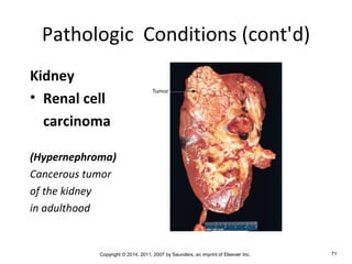 Copyright © 2014, 2011, 2007 by Saunders, an imprint of Elsevier Inc. 71
Pathologic Conditions (cont'd)
Kidney
• Renal cell
carcinoma
(Hypernephroma)
Cancerous tumor
of the kidney
in adulthood
 