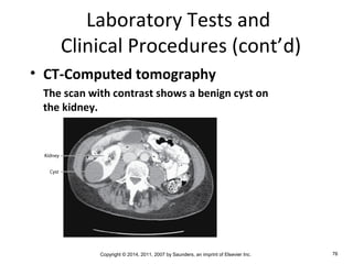 Copyright © 2014, 2011, 2007 by Saunders, an imprint of Elsevier Inc. 76
Laboratory Tests and
Clinical Procedures (cont’d)
• CT-Computed tomography
The scan with contrast shows a benign cyst on
the kidney.
 