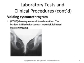 Copyright © 2014, 2011, 2007 by Saunders, an imprint of Elsevier Inc. 77
Laboratory Tests and
Clinical Procedures (cont’d)
Voiding cystourethrogram
• (VCUG)showing a normal female urethra. The
bladder is filled with contrast material, followed
by x-ray imaging.
 