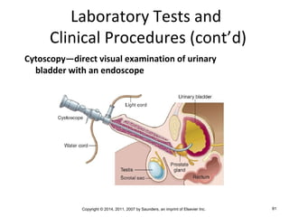 Copyright © 2014, 2011, 2007 by Saunders, an imprint of Elsevier Inc. 81
Laboratory Tests and
Clinical Procedures (cont’d)
Cytoscopy—direct visual examination of urinary
bladder with an endoscope
 