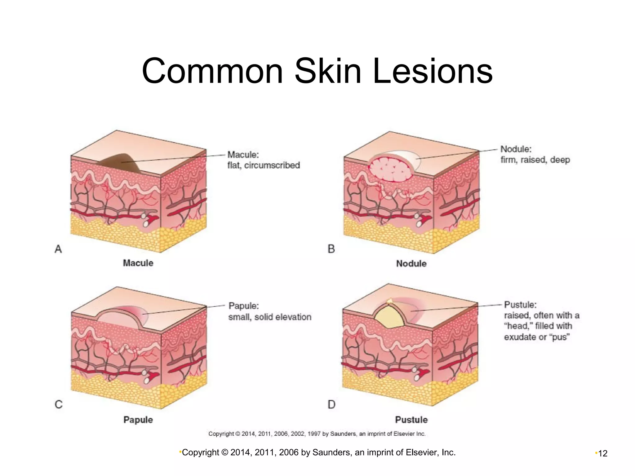 Common Skin Lesions 
•Copyright © 2014, 2011, 2006 by Saunders, an imprint of Elsevier, Inc. •12 
 