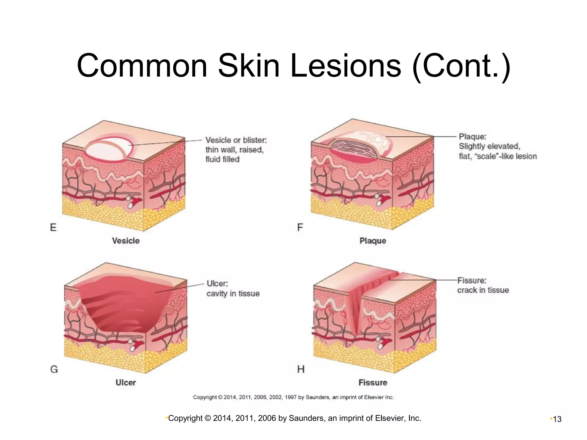 Common Skin Lesions (Cont.) 
•Copyright © 2014, 2011, 2006 by Saunders, an imprint of Elsevier, Inc. •13 
 
