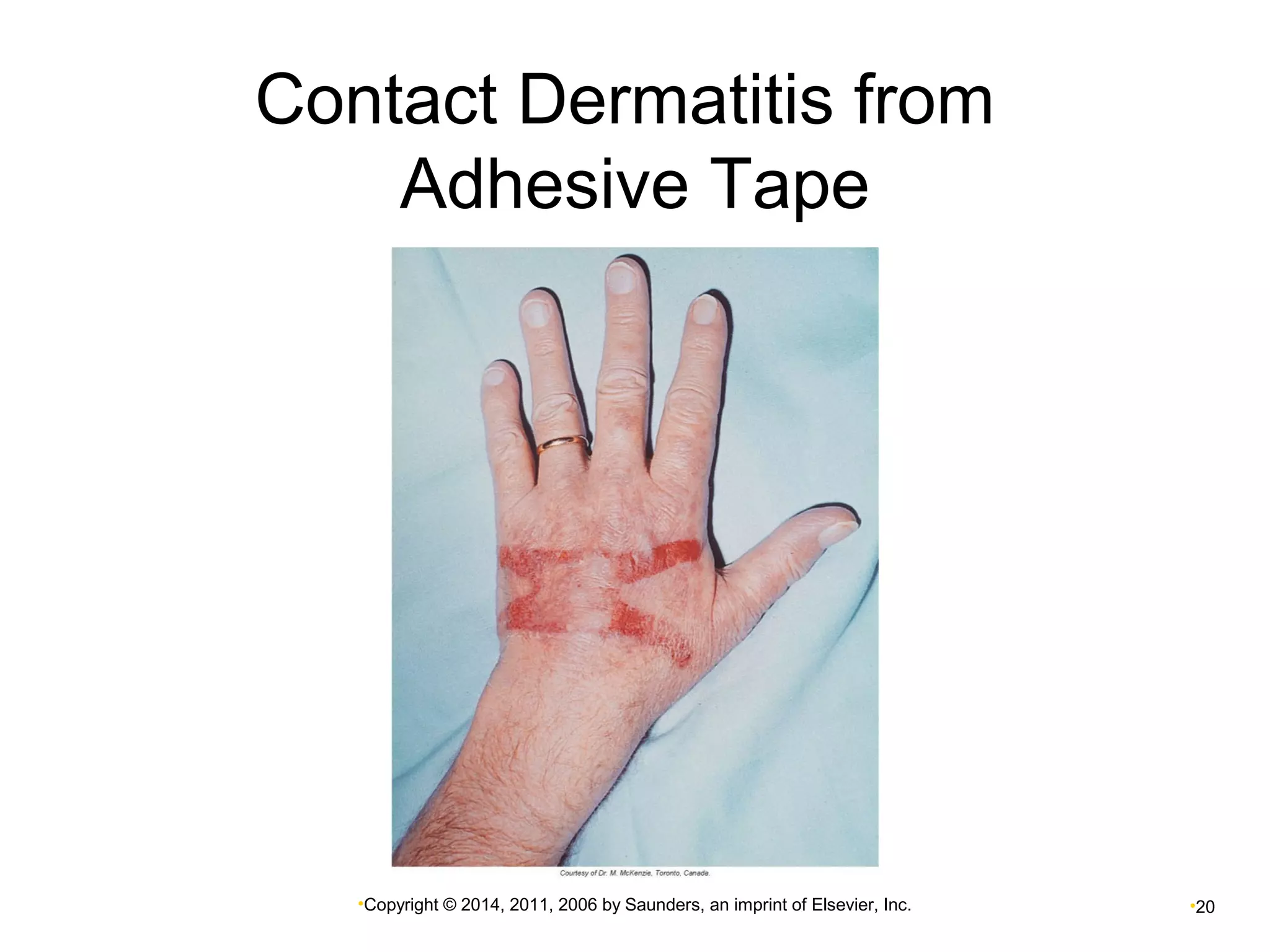 Contact Dermatitis from 
Adhesive Tape 
•Copyright © 2014, 2011, 2006 by Saunders, an imprint of Elsevier, Inc. •20 
 
