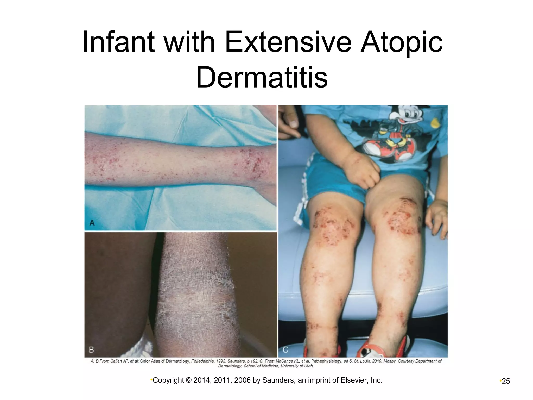 Infant with Extensive Atopic 
Dermatitis 
•Copyright © 2014, 2011, 2006 by Saunders, an imprint of Elsevier, Inc. •25 
 