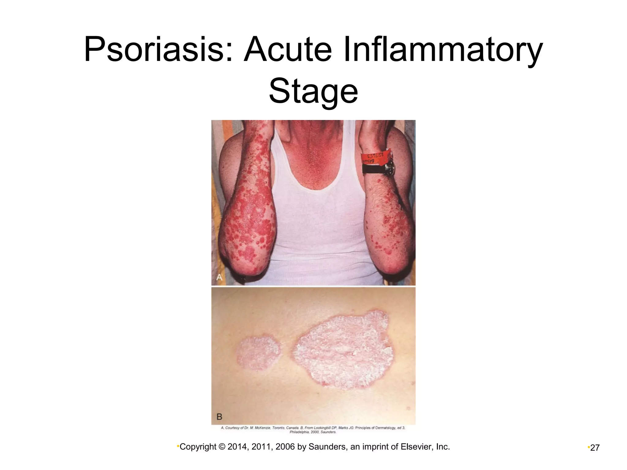 Psoriasis: Acute Inflammatory 
Stage 
•Copyright © 2014, 2011, 2006 by Saunders, an imprint of Elsevier, Inc. •27 
 