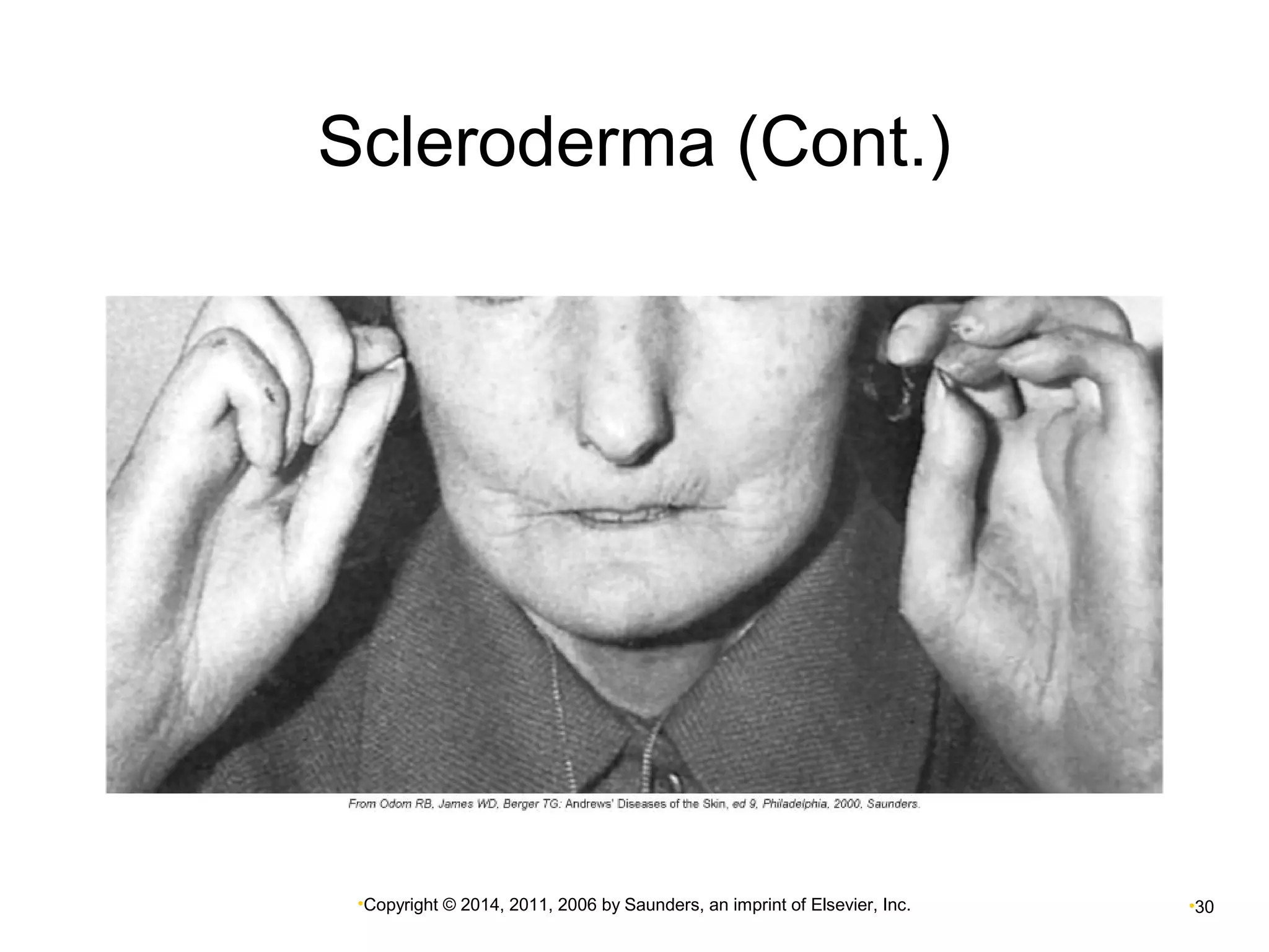 Scleroderma (Cont.) 
•Copyright © 2014, 2011, 2006 by Saunders, an imprint of Elsevier, Inc. •30 
 