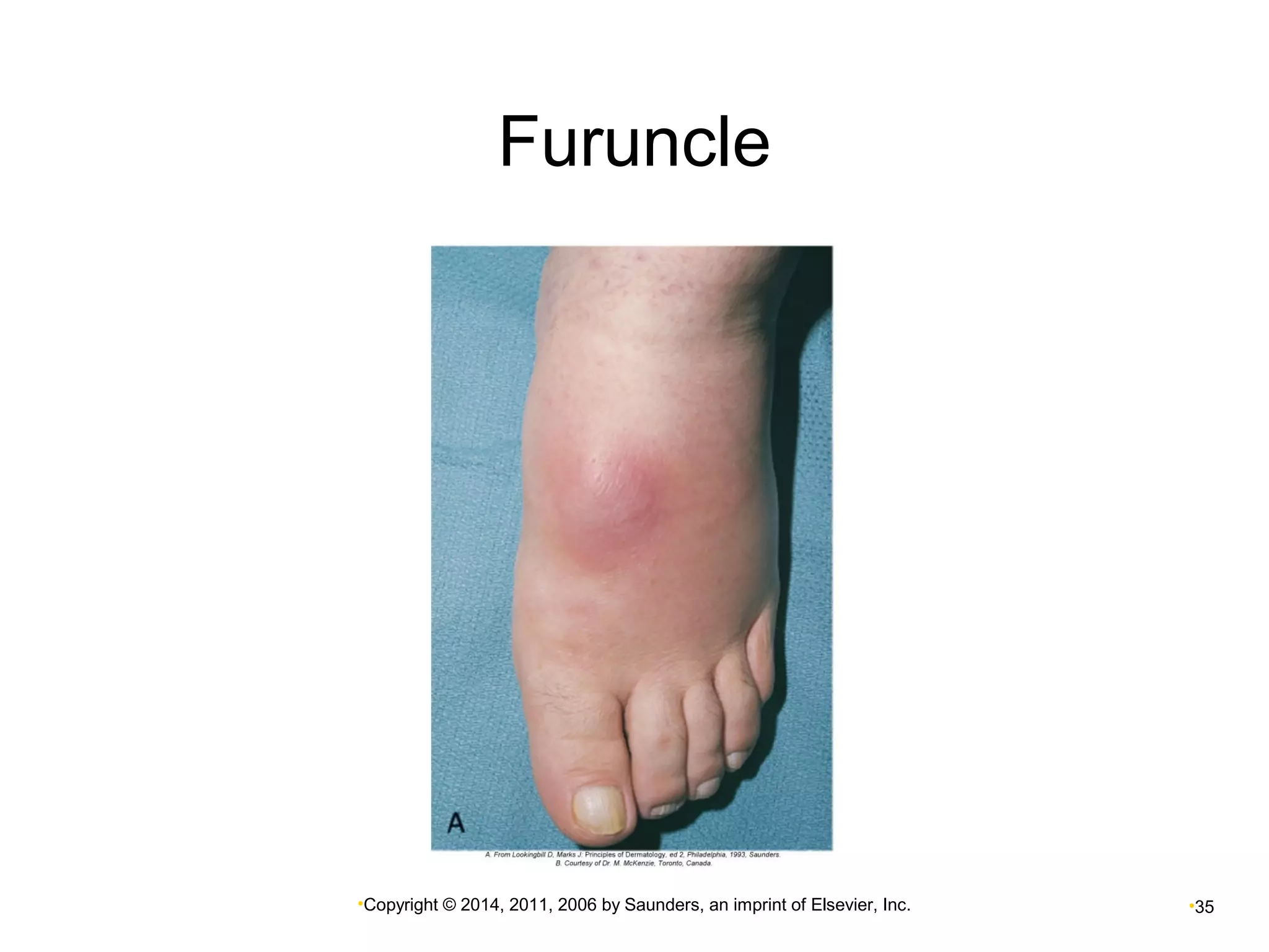 Furuncle 
•Copyright © 2014, 2011, 2006 by Saunders, an imprint of Elsevier, Inc. •35 
 