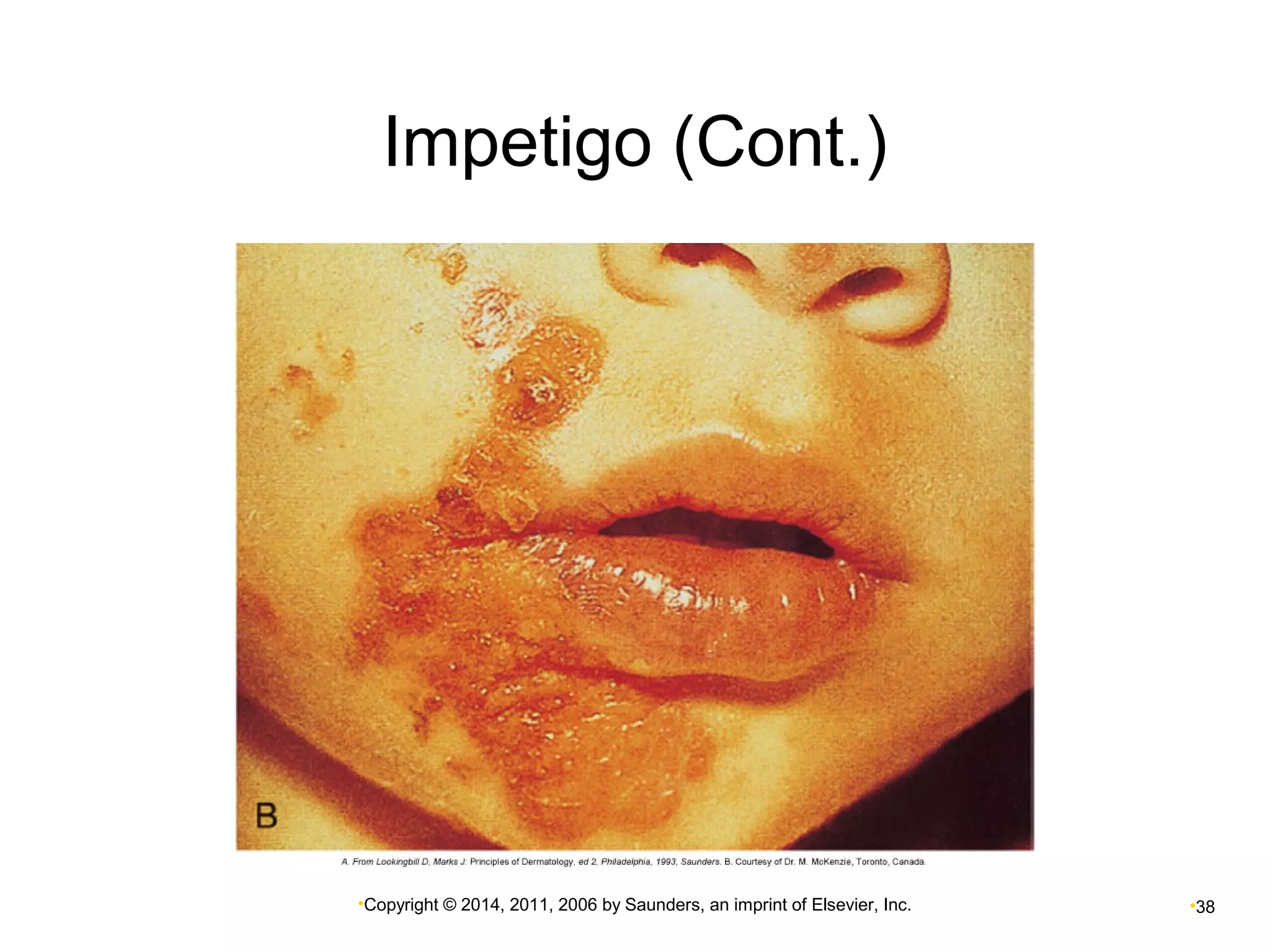 Impetigo (Cont.) 
•Copyright © 2014, 2011, 2006 by Saunders, an imprint of Elsevier, Inc. •38 
 