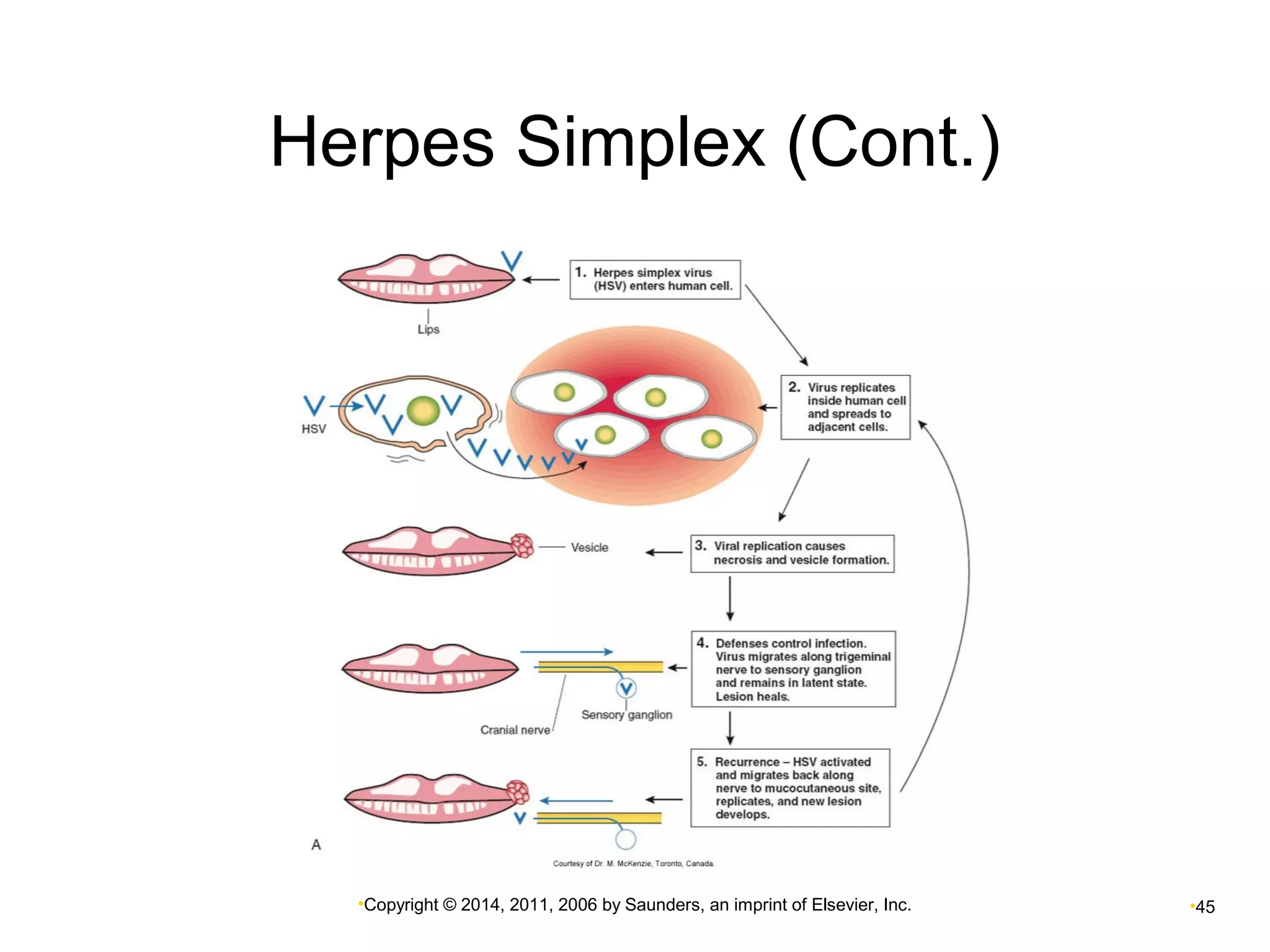 Herpes Simplex (Cont.) 
•Copyright © 2014, 2011, 2006 by Saunders, an imprint of Elsevier, Inc. •45 
 