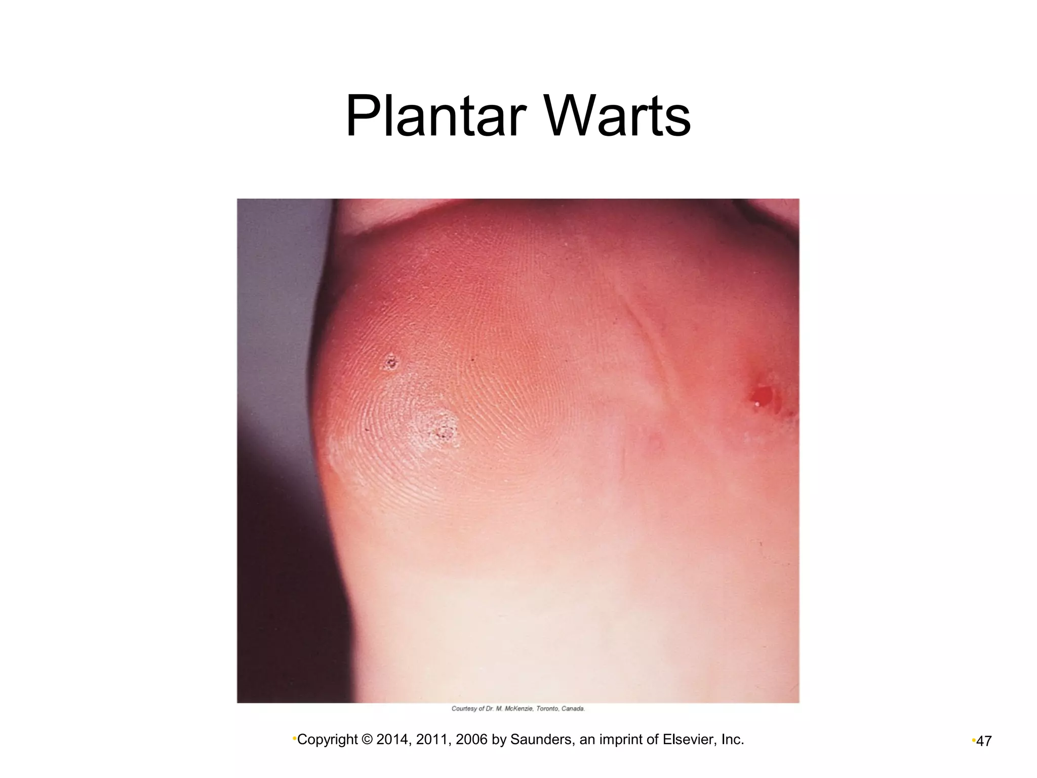 Plantar Warts 
•Copyright © 2014, 2011, 2006 by Saunders, an imprint of Elsevier, Inc. •47 
 