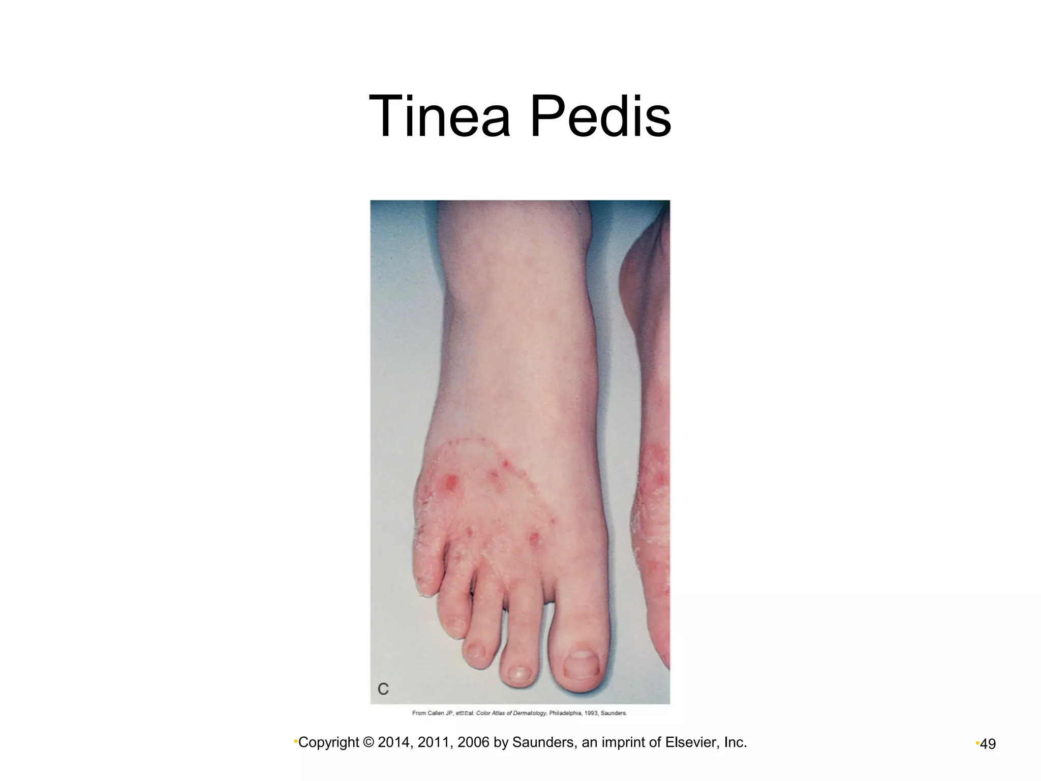 Tinea Pedis 
•Copyright © 2014, 2011, 2006 by Saunders, an imprint of Elsevier, Inc. •49 
 