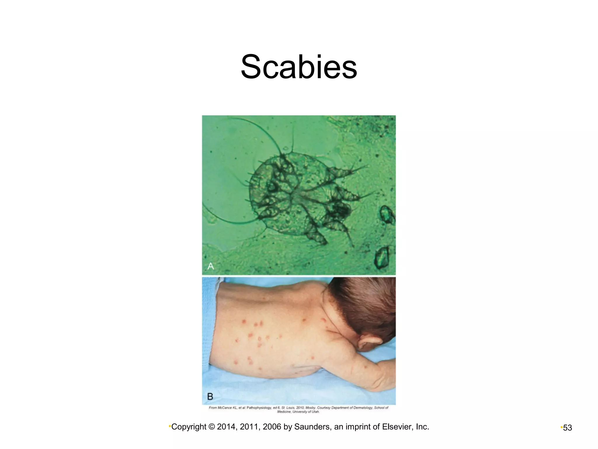 Scabies 
•Copyright © 2014, 2011, 2006 by Saunders, an imprint of Elsevier, Inc. •53 
 
