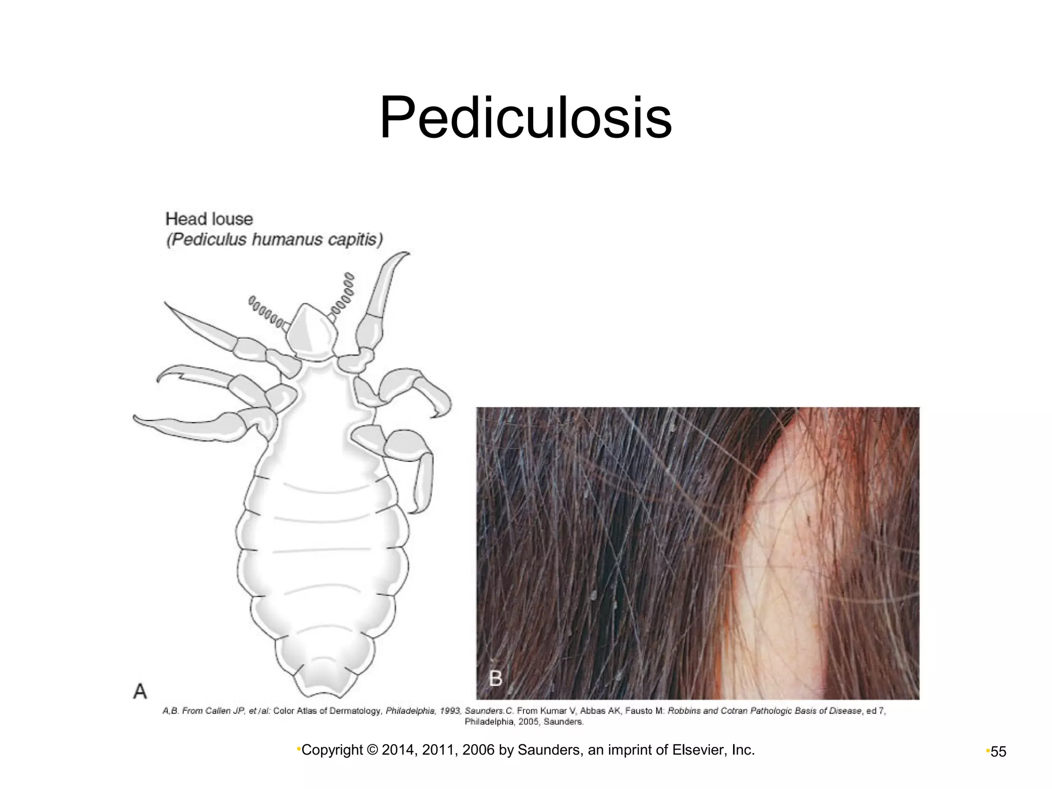Pediculosis 
•Copyright © 2014, 2011, 2006 by Saunders, an imprint of Elsevier, Inc. •55 
 
