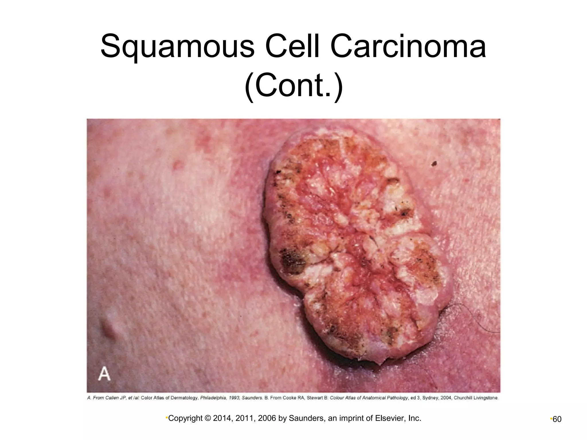 Squamous Cell Carcinoma 
(Cont.) 
•Copyright © 2014, 2011, 2006 by Saunders, an imprint of Elsevier, Inc. •60 
 