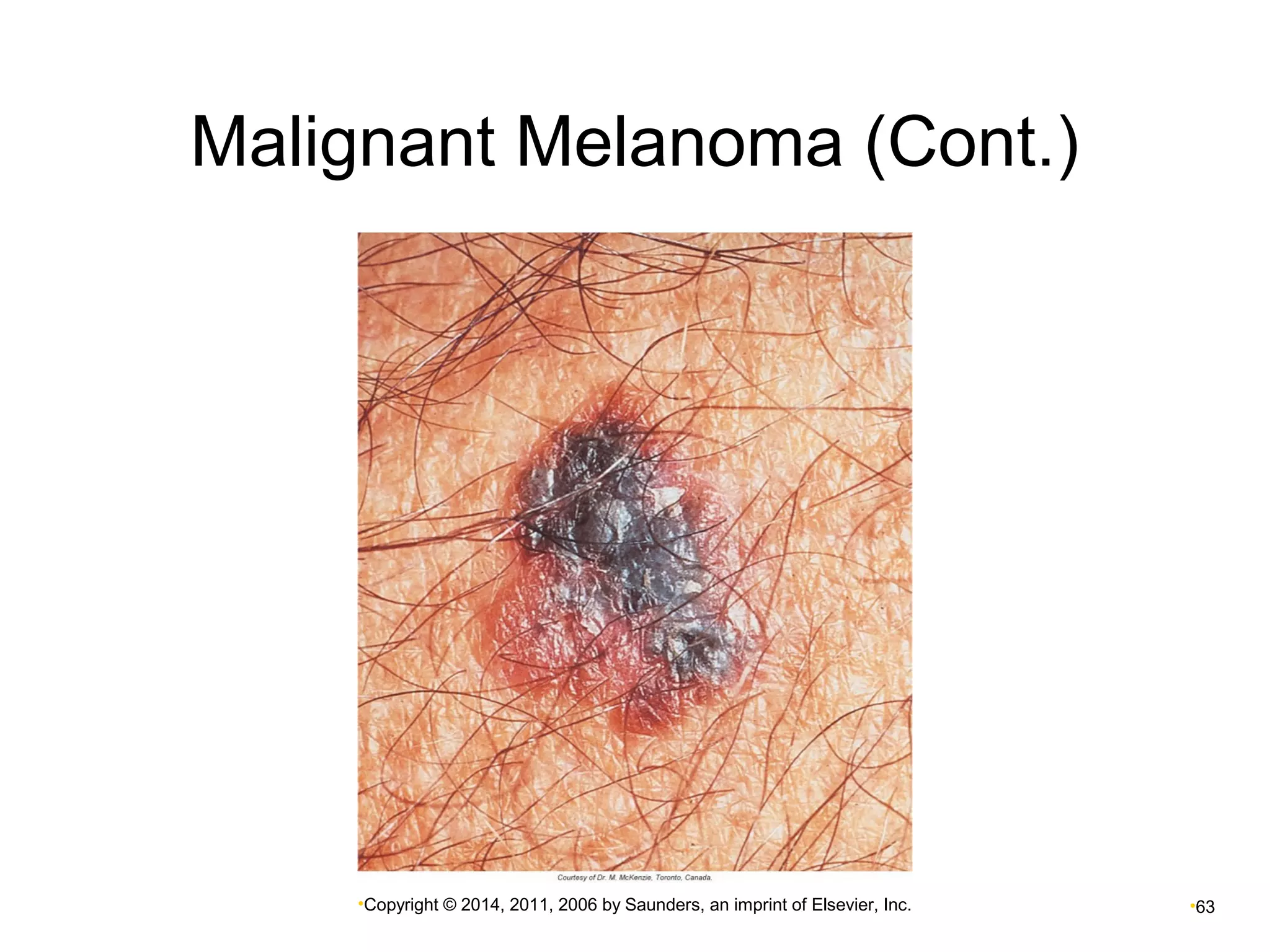 Malignant Melanoma (Cont.) 
•Copyright © 2014, 2011, 2006 by Saunders, an imprint of Elsevier, Inc. •63 
 