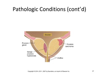 Copyright © 2014, 2011, 2007 by Saunders, an imprint of Elsevier Inc. 37
Pathologic Conditions (cont’d)
 
