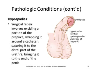Copyright © 2014, 2011, 2007 by Saunders, an imprint of Elsevier Inc. 38
Pathologic Conditions (cont’d)
Hypospadias
• Surgical repair
involves exciding a
portion of the
prepuce, wrapping it
around a catheter,
suturing it to the
distal part of the
urethra, bringing it
to the end of the
penis
 